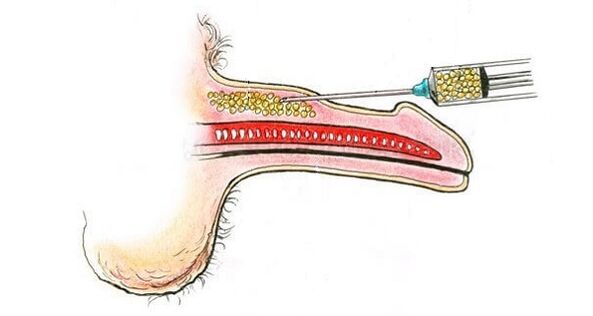 Hyaluronic acid injection into a member's barrel to increase it